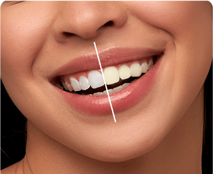 Teeth Whitening
