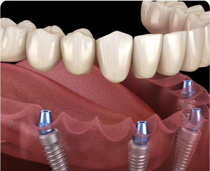 Full Mouth Reconstruction