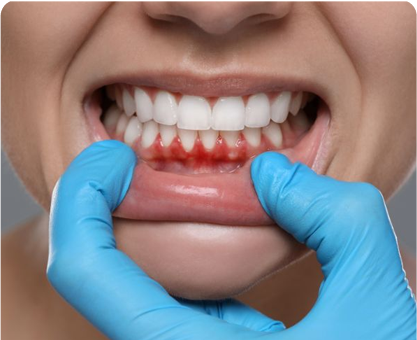 Gum Disease & Bad Breath