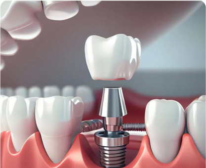 Dental Implants